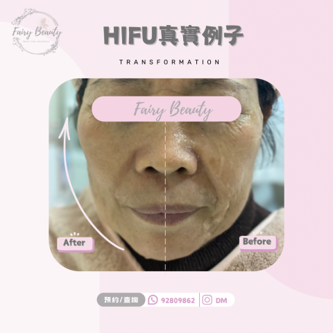Fairy Beauty - HIFU對比圖 Fairy Beauty - HIFU對比圖