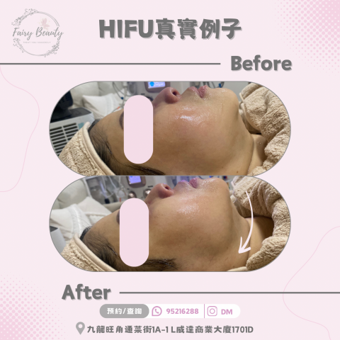 Fairy Beauty - HIFU 下顎線 對比圖 Fairy Beauty - HIFU 下顎線 對比圖