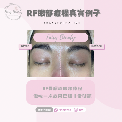 Fairy Beauty - RF骨膠原眼部 黑眼圈,眼部提升 對比圖 Fairy Beauty - RF骨膠原眼部 黑眼圈,眼部提升 對比圖