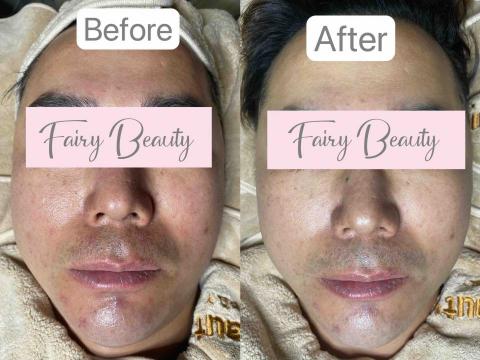 Fairy Beauty - DEO無針水光療程  Kiara Reju 對比圖 Fairy Beauty - DEO無針水光療程  Kiara Reju 對比圖
