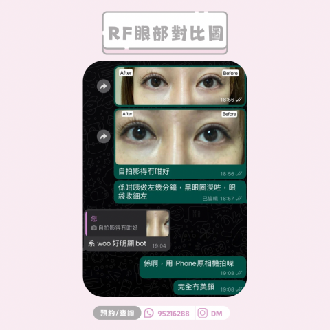 Fairy Beauty - RF骨膠原眼部療程 黑眼圈對比圖 Fairy Beauty - RF骨膠原眼部療程 黑眼圈對比圖