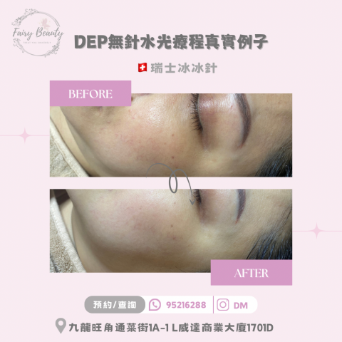 Fairy Beauty - DEP無針水光療程 冰冰針+胎盤素 對比圖 Fairy Beauty - DEP無針水光療程 冰冰針+胎盤素 對比圖
