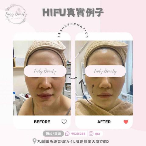 Fairy Beauty - HIFU 法令紋 對比圖 Fairy Beauty - HIFU 法令紋 對比圖