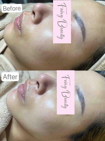 Fairy Beauty - DEP無針水光療程 冰冰針 對比圖 Fairy Beauty - DEP無針水光療程 冰冰針 對比圖