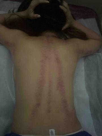 Coco Tso - 刮痧 Coco Tso - 刮痧