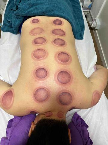 Coco Tso - 拔罐 Coco Tso - 拔罐