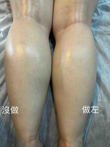 無痛專門店 - 岩鹽石做咗一邊的效果 無痛專門店 - 岩鹽石做咗一邊的效果