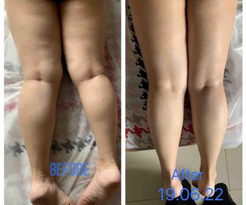 Jessica The Therapy - 客人腳部嚴重水腫,幫她做了推油舒筋排水腫治療,其後腳的長短不一有改善 Jessica The Therapy - 客人腳部嚴重水腫,幫她做了推油舒筋排水腫治療,其後腳的長短不一有改善