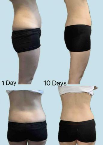 Jessica The Therapy - 客人產後一個多月開始做10天療程,盆骨修復和紮肚 Jessica The Therapy - 客人產後一個多月開始做10天療程,盆骨修復和紮肚