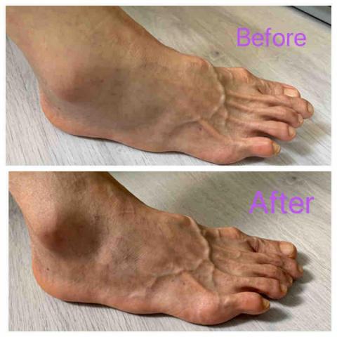 Jessica The Therapy - 客人扭傷腳踝,治療後消痛且不用看跌打 Jessica The Therapy - 客人扭傷腳踝,治療後消痛且不用看跌打