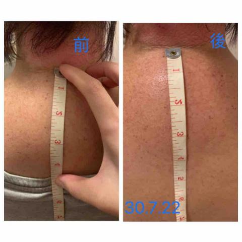 Jessica The Therapy - 客人有富貴包,做了5次療程後有明顯改善 Jessica The Therapy - 客人有富貴包,做了5次療程後有明顯改善