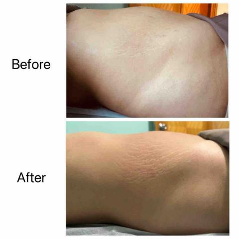 Jessica The Therapy - 客人肚有風濕寒情況,做了產後排風濕及經絡穴位按摩。 Jessica The Therapy - 客人肚有風濕寒情況,做了產後排風濕及經絡穴位按摩。