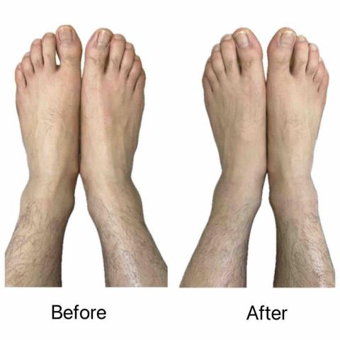 Jessica The Therapy - 客人有長短腳,足底筋膜炎和坐骨神經痛,經治療後減緩痛楚。 Jessica The Therapy - 客人有長短腳,足底筋膜炎和坐骨神經痛,經治療後減緩痛楚。