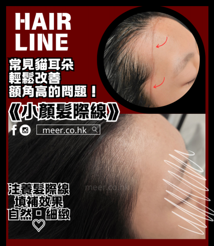 meer.co.hk 紋髮育髮美妝店 - 小顏髮際線: 獨家排線技術, 即時改善額角高的問題, 同時幫你生髮 meer.co.hk 紋髮育髮美妝店 - 小顏髮際線: 獨家排線技術, 即時改善額角高的問題, 同時幫你生髮