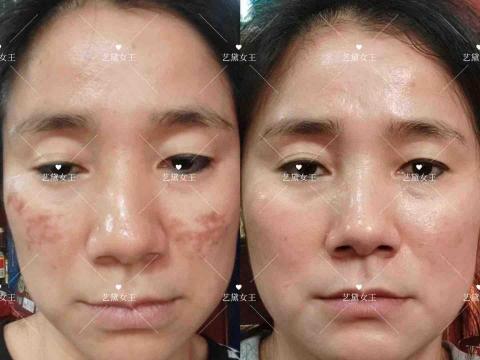 袪斑專家 - 堅持聽話照做，反彈不存在的！
助女士走在去斑市場最前沿！