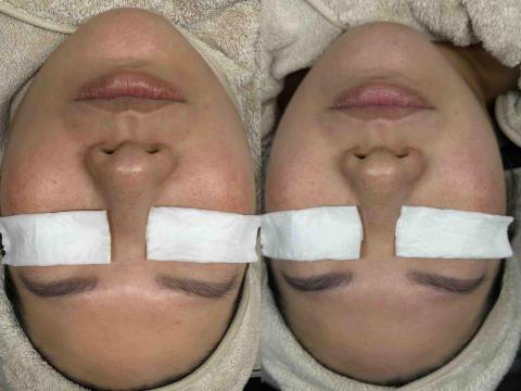 beauty_Fi - 無創微針