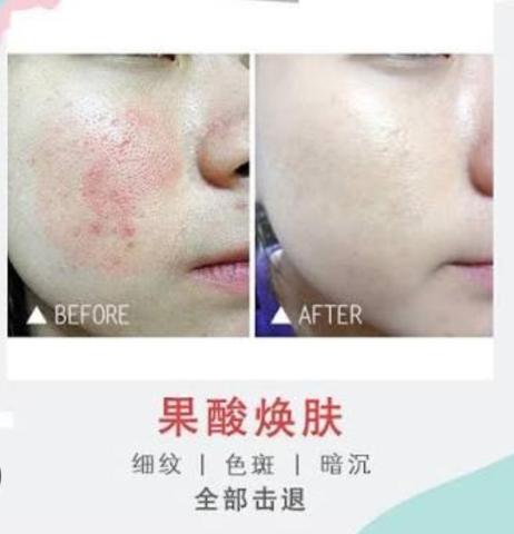 SD Beauty - 牛奶果酸 專業換膚